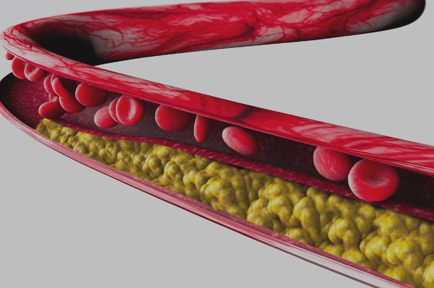 cardiovascular disease