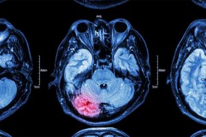 traumatic brain injury and the ketogenic diet