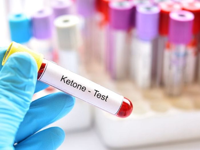 ketoacidosis - ketone test