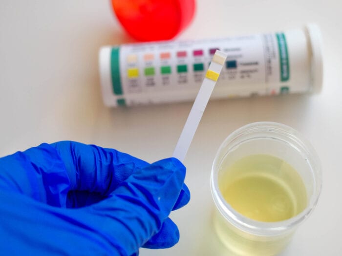 Testing for ketones in urine