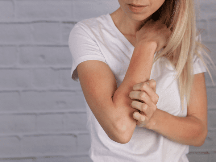 Keto can improve symptoms of eczema