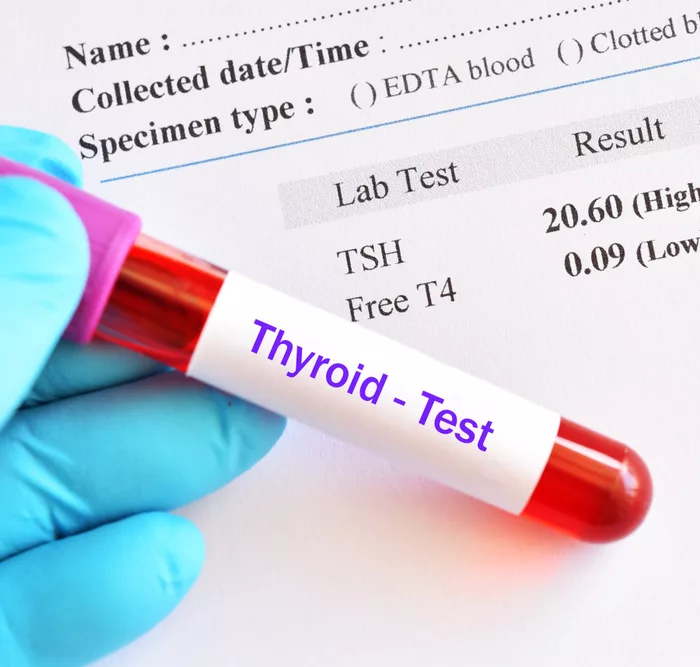 Thyroid test for hypothyroidism